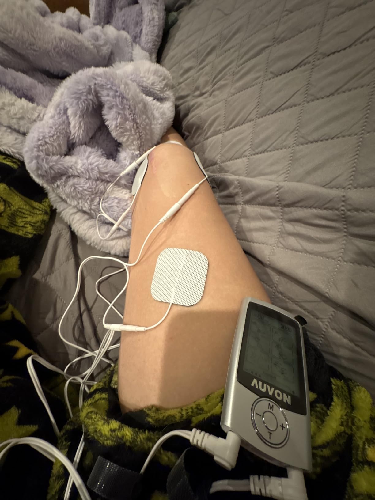AUVON 24 Modes TENS Unit Muscle Stimulator for Pain Relief, Premium Pads customer photo 1